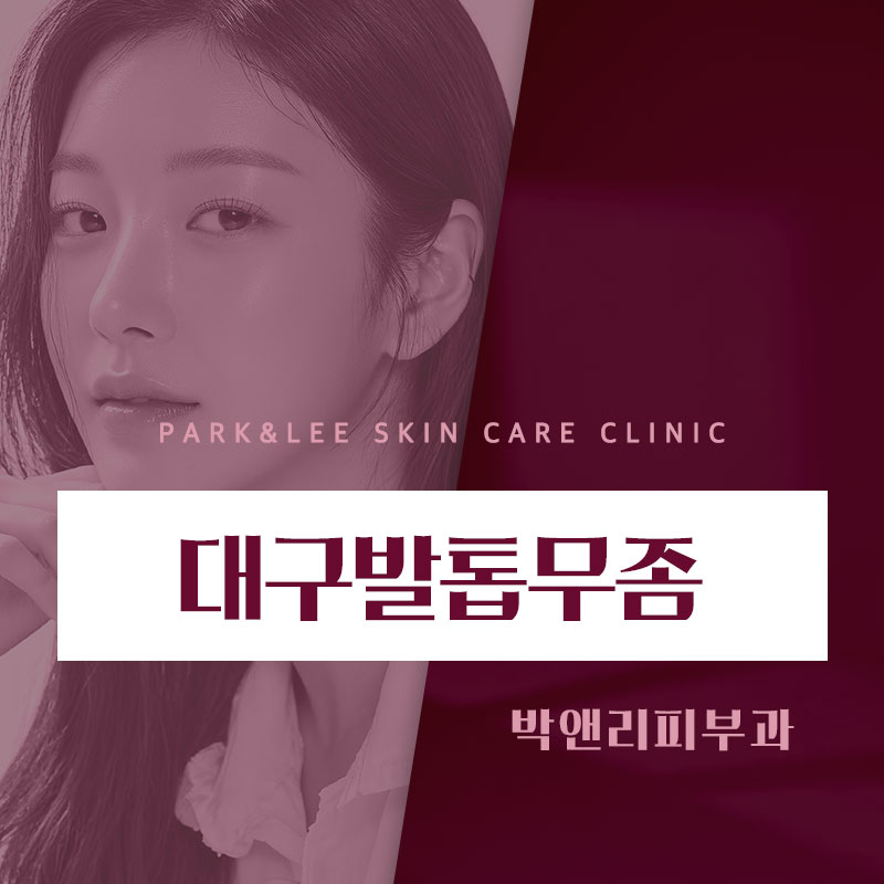 대구발톱무좀